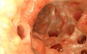 Diverticolite (infiammazione dei diverticoli): cause, diagnosi, trattamento