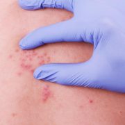 Herpes Zoster (fuoco di sant'Antonio): sintomi, diagnosi e trattamenti